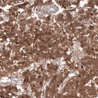 Immunohistochemical staining of human ovarian cancer (dysgeminoma) shows strong membranous and cytoplasmic positivity in tumor cells.