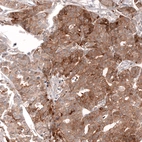 Immunohistochemical staining of human ovarian cancer (high grade serous ovarian carcinoma) shows strong cytoplasmic positivity in tumor cells.