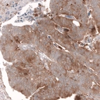 Immunohistochemical staining of human colorectal cancer shows moderate cytoplasmic positivity in tumor cells.