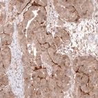 Immunohistochemical staining of human ovarian cancer (papillary carcinoma) shows moderate to strong cytoplasmic and memrbanous positivity in tumor cells.