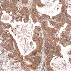 Immunohistochemical staining of human colorectal cancer shows moderate cytoplasmic positivity in tumor cells.