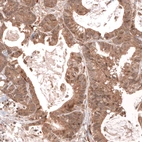 Immunohistochemical staining of human colorectal cancer shows moderate cytoplasmic positivity in tumor cells.