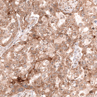 Immunohistochemical staining of human ovarian cancer (endometrioid carcinoma) shows moderate cytoplasmic positivity in tumor cells.