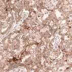 Immunohistochemical staining of human ovarian cancer (endometrioid carcinoma) shows moderate cytoplasmic positivity in tumor cells.