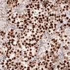Immunohistochemical staining of human testis cancer (seminoma) shows strong nuclear positivity in tumor cells.