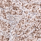 Immunohistochemical staining of human breast cancer (ductal carcinoma) shows strong nuclear positivity in tumor cells.