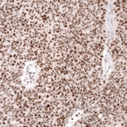 Immunohistochemical staining of human ovarian cancer (high grade serous ovarian carcinoma) shows strong nuclear positivity in tumor cells.