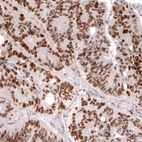 Immunohistochemical staining of human colorectal cancer shows strong nuclear positivity in tumor cells.