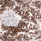 Immunohistochemical staining of human testis cancer (embryonal carcinoma) shows strong nuclear positivity in tumor cells.