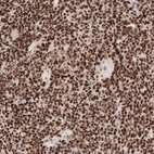 Immunohistochemical staining of human ovarian cancer (high grade serous carcinoma) shows strong nuclear positivity in tumor cells.