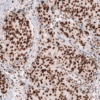 Immunohistochemical staining of human breast cancer (ductal carcinoma) shows strong nuclear positivity in tumor cells.
