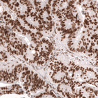Immunohistochemical staining of human colorectal cancer (metastasis to ovary) shows strong nuclear positivity in tumor cells.