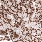 Immunohistochemical staining of human colorectal cancer (metastasis to ovary) shows strong nuclear positivity in tumor cells.