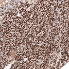 Immunohistochemical staining of human ovarian cancer (sex cord tumor) shows strong nuclear positivity in tumor cells.