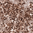 Immunohistochemical staining of human testis cancer (seminoma) shows strong nuclear positivity in tumor cells.