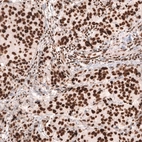Immunohistochemical staining of human breast cancer (ductal carcinoma) shows strong nuclear positivity in tumor cells.