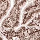 Immunohistochemical staining of human colorectal cancer shows strong nuclear positivity in tumor cells.