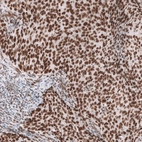 Immunohistochemical staining of human endometrial cancer shows strong nuclear positivity in tumor cells.