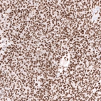 Immunohistochemical staining of human ovarian cancer (high grade serous carcinoma) shows strong nuclear positivity in tumor cells.