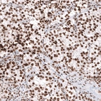 Immunohistochemical staining of human testis cancer (seminoma) shows strong nuclear positivity in tumor cells.