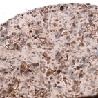 Immunohistochemical staining of human glioblastoma multiforme shows moderate to strong cytoplasmic positivity in tumor cells.