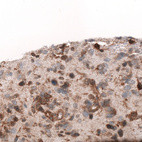 Immunohistochemical staining of human glioblastoma multiforme shows moderate to strong cytoplasmic positivity in tumor cells.
