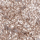 Immunohistochemical staining of human kidney cancer shows moderate to strong membranous positivity in tumor cells.
