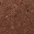 Immunohistochemical staining of human anaplastic oligodendroglioma shows strong cytoplasmic positivity in tumor cells.
