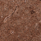 Immunohistochemical staining of human anaplastic oligodendroglioma shows strong cytoplasmic positivity in tumor cells.