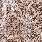 Immunohistochemical staining of human breast cancer (ductal carcinoma) shows strong nuclear positivity in tumor cells.