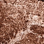 Immunohistochemical staining of human cervical cancer shows strong nuclear positivity in tumor cells.