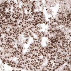 Immunohistochemical staining of human testis cancer (embryonal carcinoma) shows strong nuclear positivity in tumor cells.