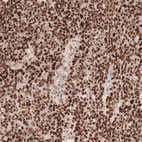 Immunohistochemical staining of human ovarian cancer (high grade serous carcinoma) shows strong nuclear positivity in tumor cells.