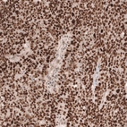 Immunohistochemical staining of human ovarian cancer (high grade serous carcinoma) shows strong nuclear positivity in tumor cells.