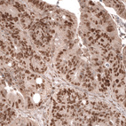 Immunohistochemical staining of human colorectal cancer shows strong nuclear positivity in tumor cells.