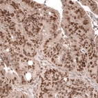 Immunohistochemical staining of human colorectal cancer shows strong nuclear positivity in tumor cells.
