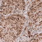 Immunohistochemical staining of human breast cancer (ductal carcinoma) shows strong nuclear positivity in tumor cells.