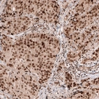 Immunohistochemical staining of human breast cancer (ductal carcinoma) shows strong nuclear positivity in tumor cells.