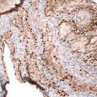 Immunohistochemical staining of human ovarian cancer (mucinous) shows strong nuclear positivity in tumor cells.