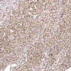Immunohistochemical staining of human ovarian cancer (sex cord tumor) shows moderate nuclear positivity in tumor cells.