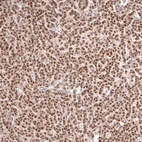 Immunohistochemical staining of human ovarian cancer (granulosa cell tumor) shows moderate nuclear positivity in tumor cells.