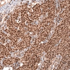 Immunohistochemical staining of human ovarian cancer (sex cord tumor) shows strong nuclear positivity in tumor cells.