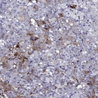 Immunohistochemical staining of human adrenal gland shows moderate cytoplasmic positivity in a subset of glandular cells in medulla.