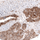 Immunohistochemical staining of human ovarian cancer (papillary carcinoma) shows strong membranous positivity in tumor cells.