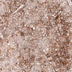 Immunohistochemical staining of human breast cancer shows strong membranous positivity in tumor cells.