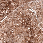 Immunohistochemical staining of human breast cancer shows strong membranous positivity in tumor cells.