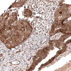 Immunohistochemical staining of human ovarian cancer (papillary carcinoma) shows strong membranous positivity in tumor cells.