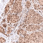 Immunohistochemical staining of human breast cancer shows moderate to strong nuclear positivity in tumor cells.