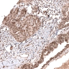 Immunohistochemical staining of human ovarian cancer (papillary ovarian carcinoma) shows moderate nuclear positivity in tumor cells.