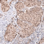 Immunohistochemical staining of human breast cancer shows moderate to strong nuclear positivity in tumor cells.